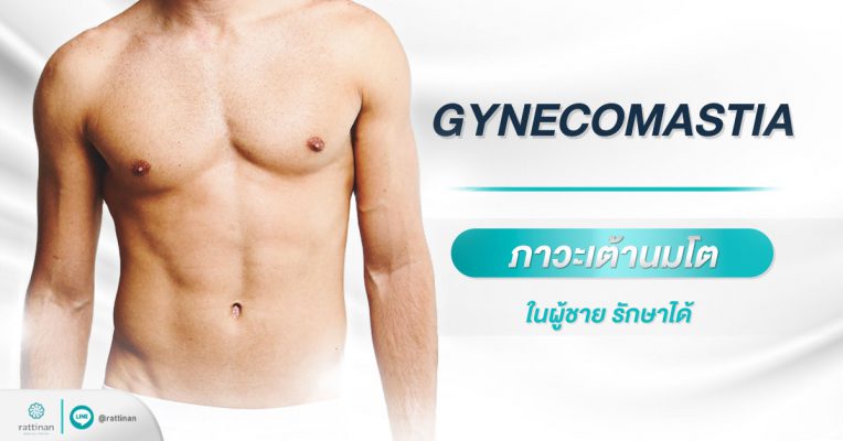 Gynecomastia ภาวะเต้านมโตในผู้ชาย